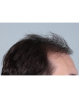 Before Hair Transplant&nbsp;Front
